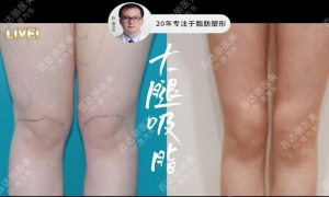 唐为东医生首创低压柔性吸脂安全满足消费者美体需求